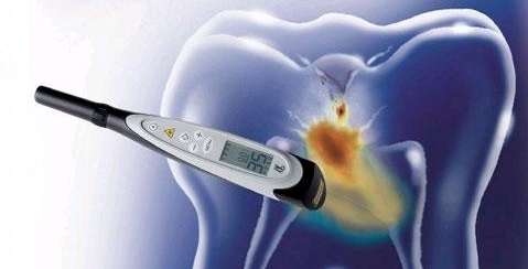 Diagnodent | Dentist