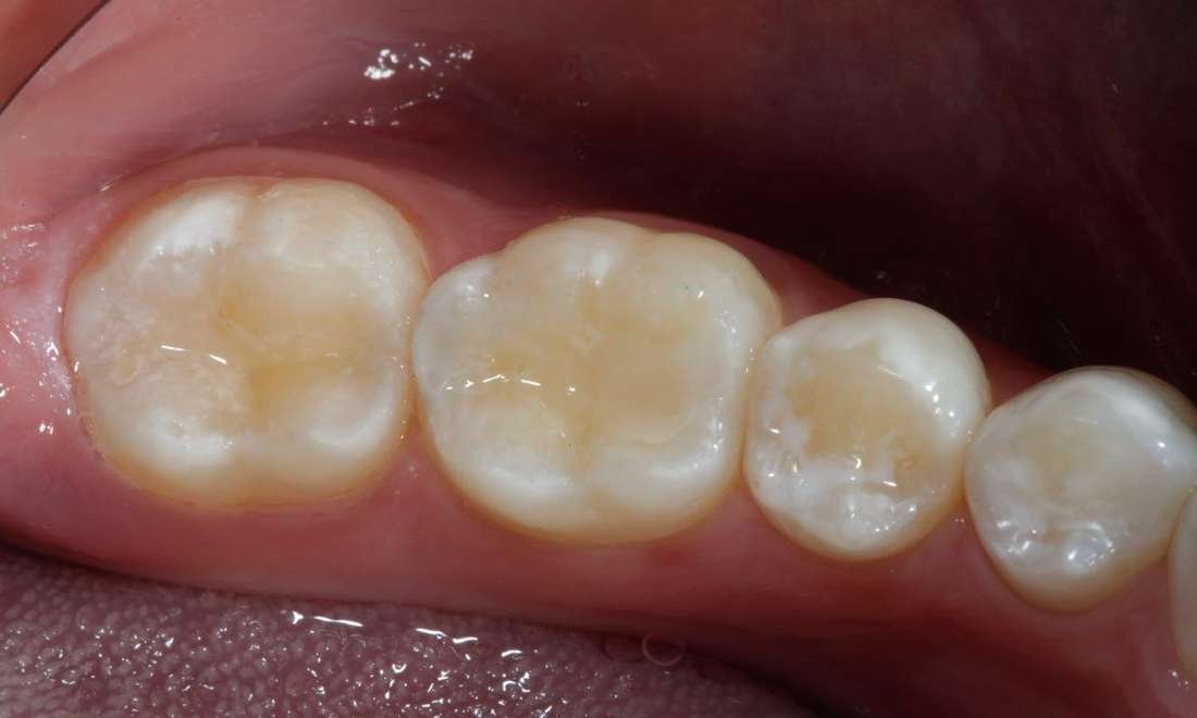 Composite or “Tooth Colored” Fillings - Albany