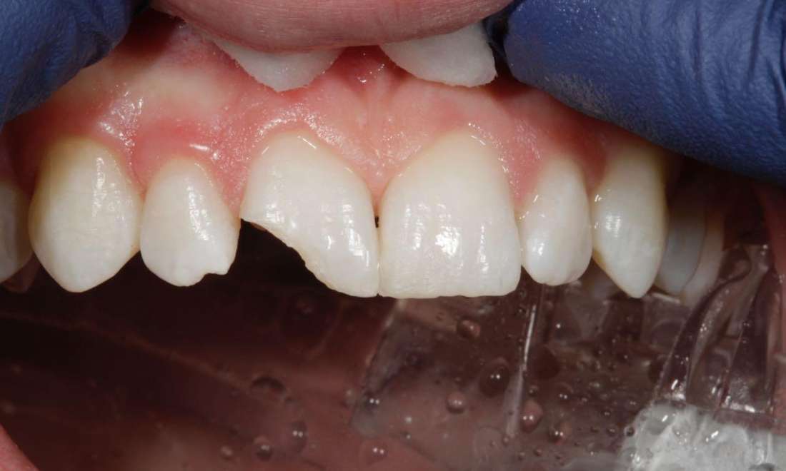 Before & After Photos, Cracked Tooth Repair Gallery