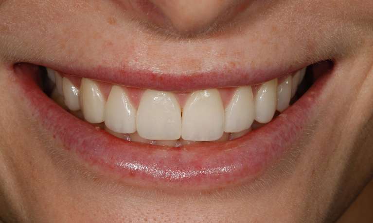 CADSMILES-Same-Day-Veneers-Using-CEREC-Technology-After-Image