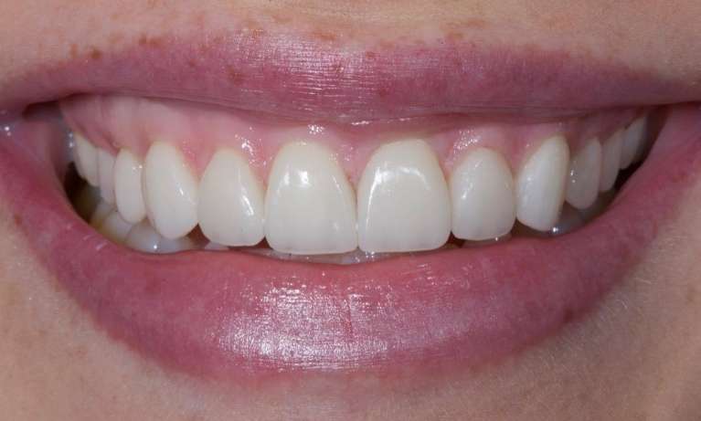 CADSMILES-Same-Day-Veneers-Using-CEREC-Technology-After-Image