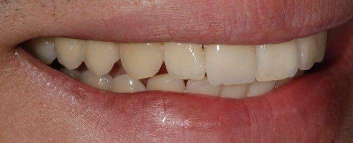 Chipped-single-front-tooth-before-ceramic-same-day-CEREC-crown-After-Image