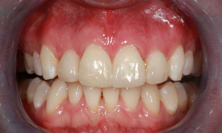 Corrected-Bonded-Composite-Fillings-After-Image
