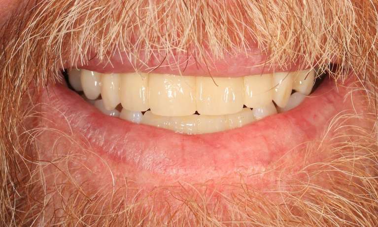 Implant-Restorations-After-Image