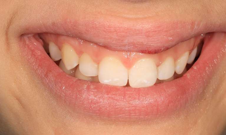 Laser-Assisted-Anterior-Bonding-After-Image