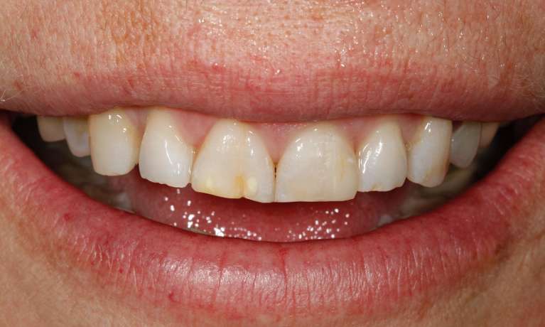 Laser-Composites-After-Image