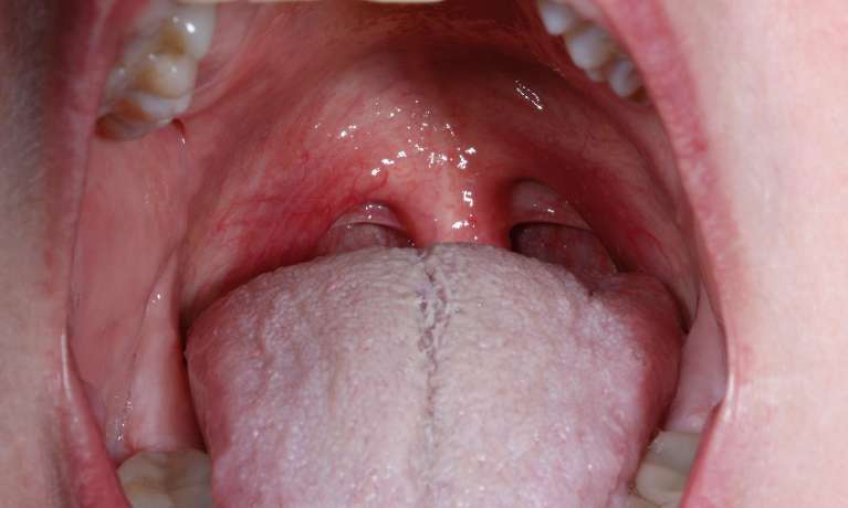 Nightlase-Snoring-Solution-After-Image