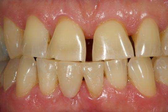 Replacement-of-old-lower-bridge-After-Image