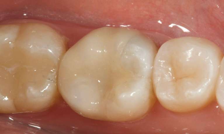 Replacing-mercury-amalgam-cracked-tooth-with-CEREC-onlay-After-Image