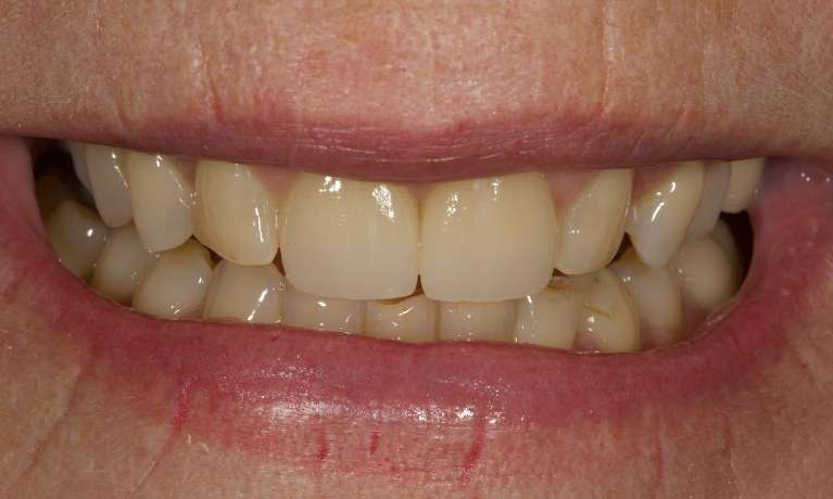 Replacing-two-old-crowns-with-two-CEREC-same-day-crowns-After-Image