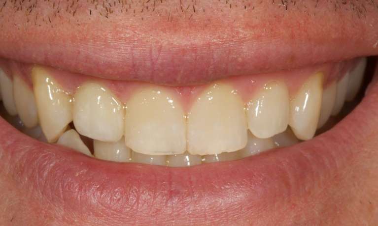 Root-canal-post-CEREC-crown-After-Image