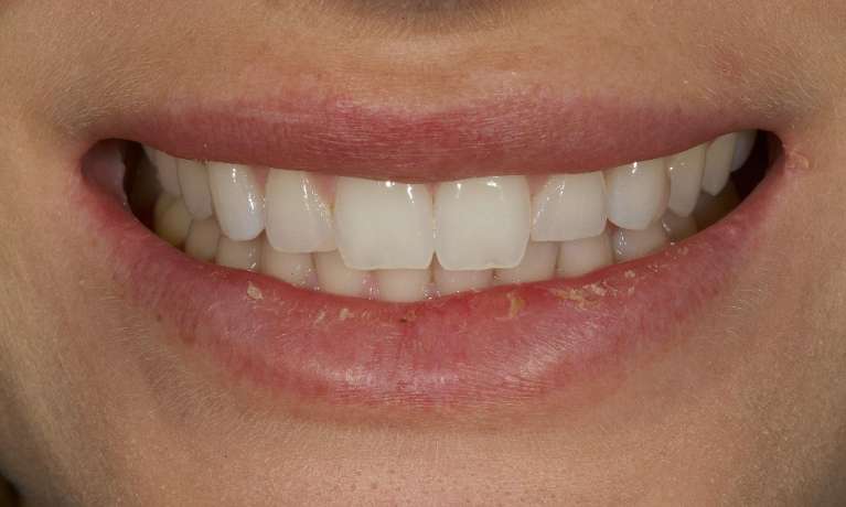 CADSMILES-Same-Day-Veneers-Using-CEREC-Technology-Before-Image