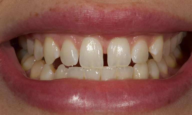 CADSMILES-Same-Day-Veneers-Using-CEREC-Technology-Before-Image