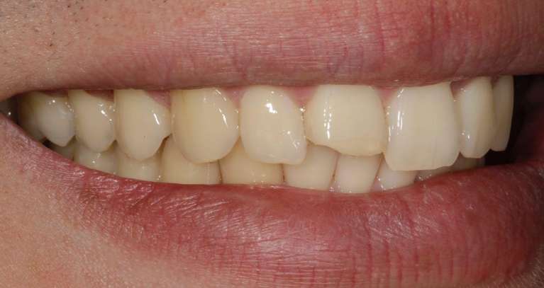Chipped-single-front-tooth-before-ceramic-same-day-CEREC-crown-Before-Image
