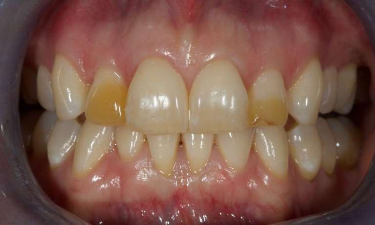 Corrected-Bonded-Composite-Fillings-Before-Image