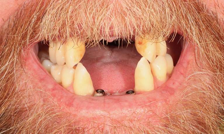 Implant-Restorations-Before-Image