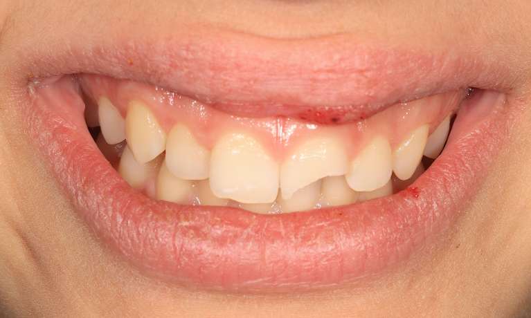 Laser-Assisted-Anterior-Bonding-Before-Image