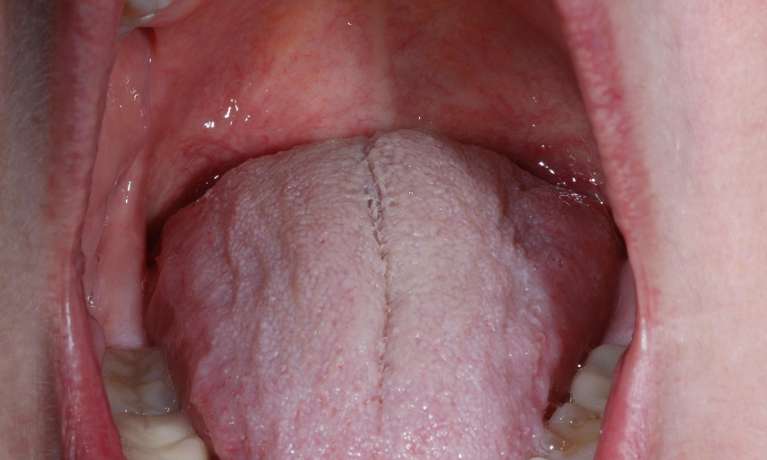 Nightlase-Snoring-Solution-Before-Image
