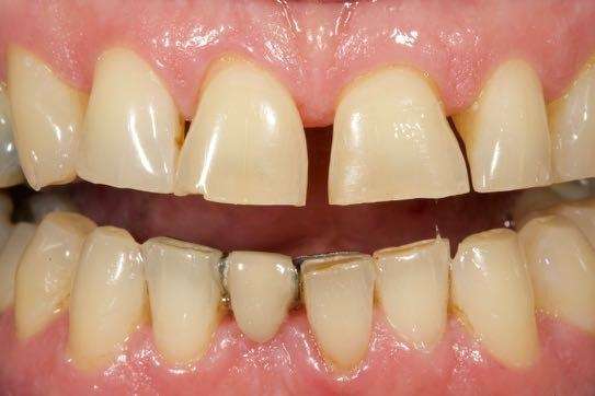 Replacement-of-old-lower-bridge-Before-Image