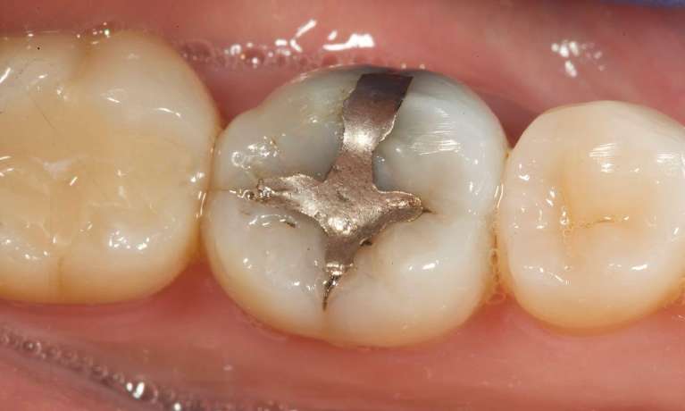 Replacing-mercury-amalgam-cracked-tooth-with-CEREC-onlay-Before-Image