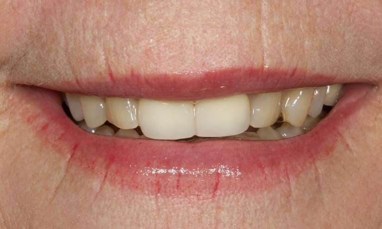 Replacing-two-old-crowns-with-two-CEREC-same-day-crowns-Before-Image