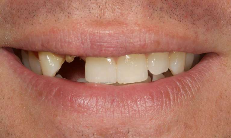 Root-canal-post-CEREC-crown-Before-Image