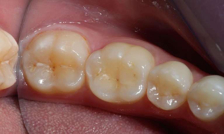 White-composite-filling-using-laser-Before-Image